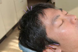 顔面神経麻痺の鍼治療PAPT療法