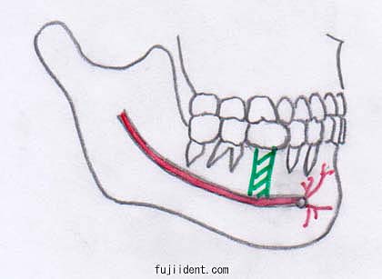 下歯槽神経麻痺、オトガイ神経麻痺を起こしやすいインプラントの植立状態2