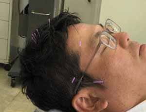 顔面神経麻痺の鍼治療papt療法2