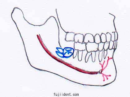 親知らず抜歯により麻痺を起こしやすい親知らずの生え方2