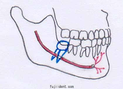 親知らず抜歯により麻痺を起こしやすい親知らずの生え方3