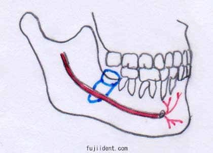 親知らず抜歯により麻痺を起こしやすい親知らずの生え方4